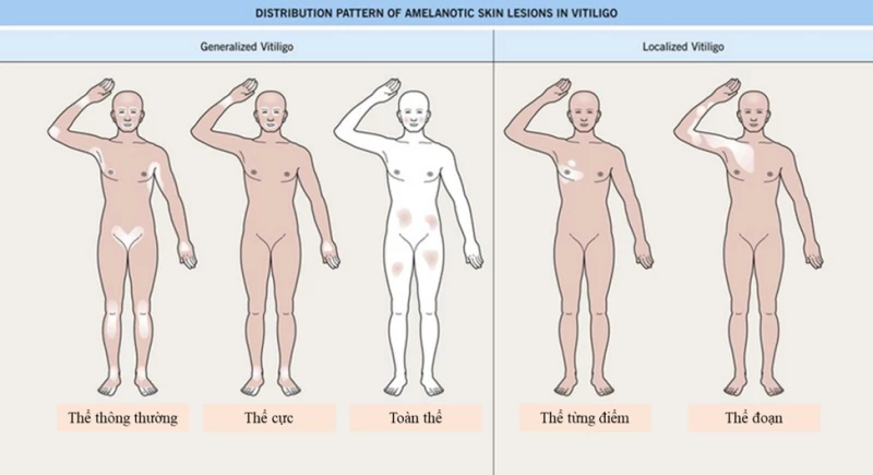 Phân loại các thể lâm sàng của bạch biến.